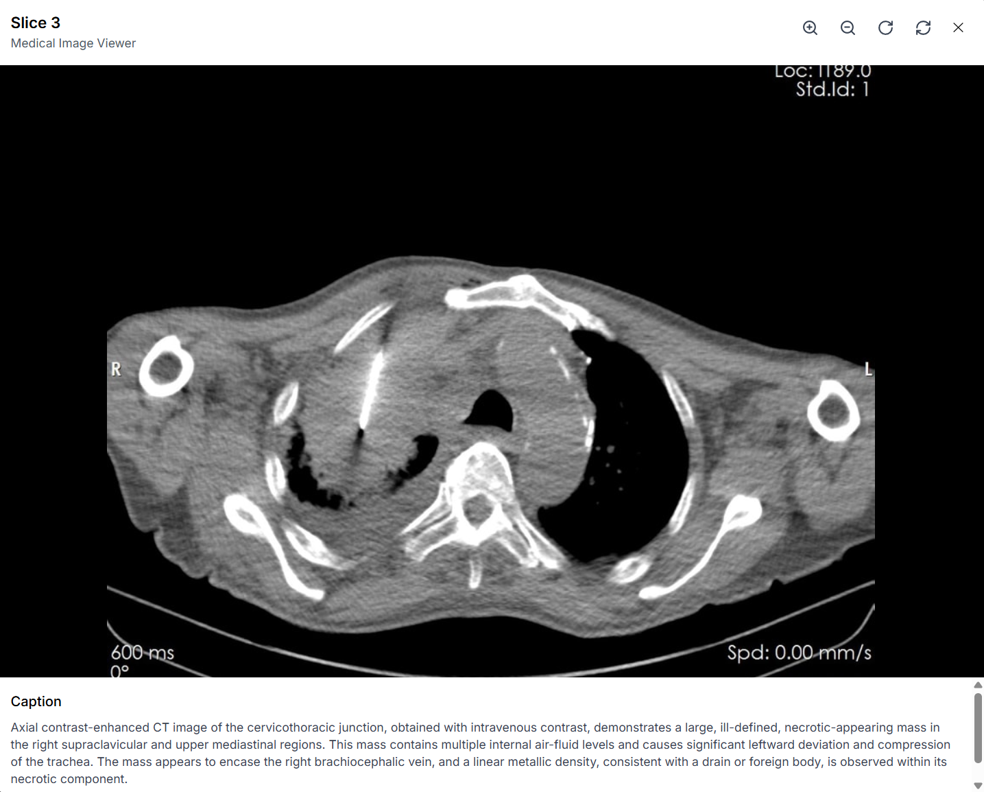 MedChronos Medical Image Viewer showing CT scan with AI-generated caption